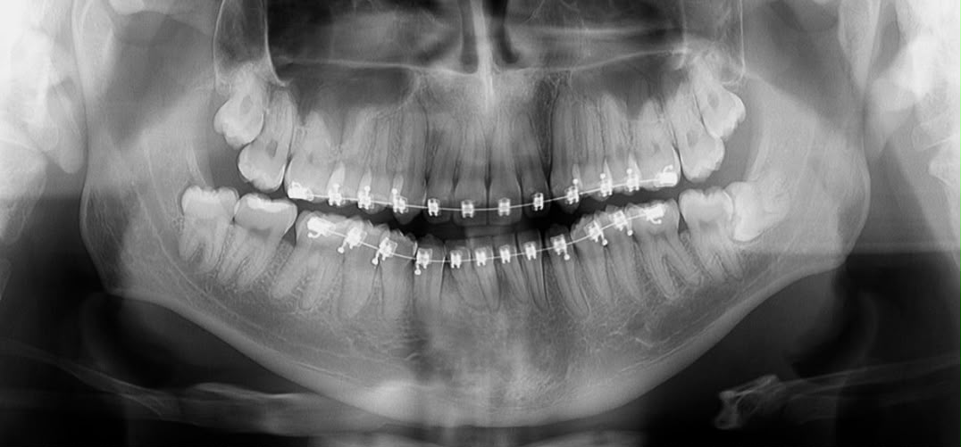Cirurgia oral menor e siso