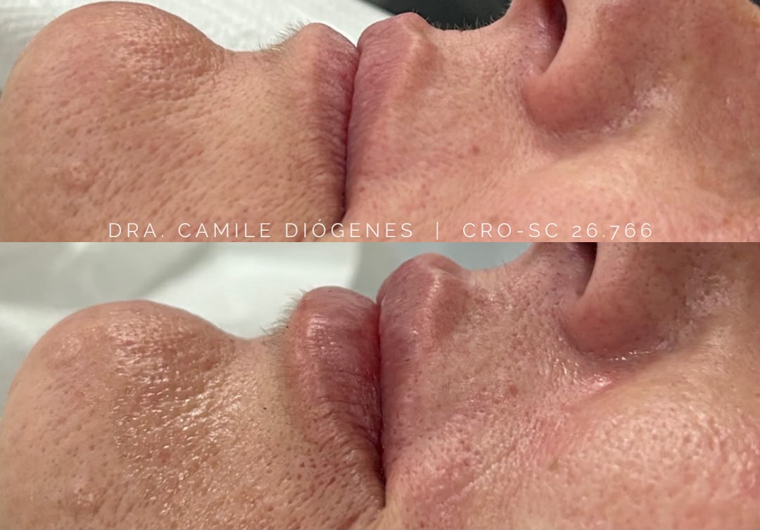 Preenchimento Labial